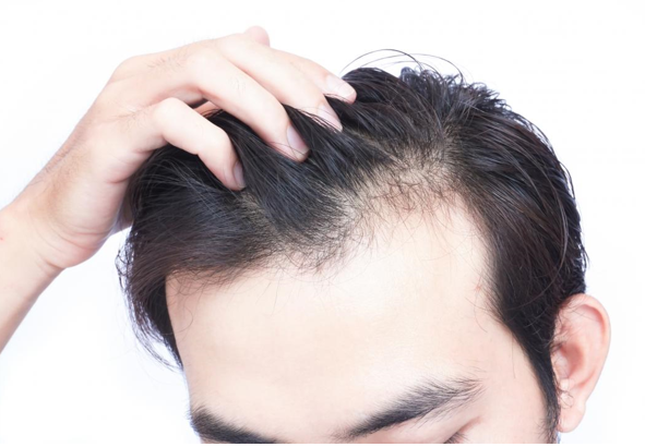 How to Stop Hair Loss,